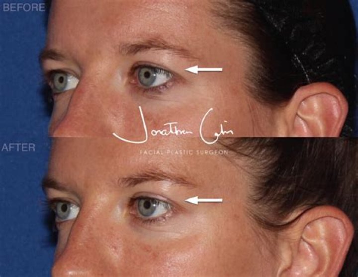 The FACE of FACIAL REJUVENATION, FACELIFTS, EYELID LIFTS, NECK LIFT, AND BROW LIFTS